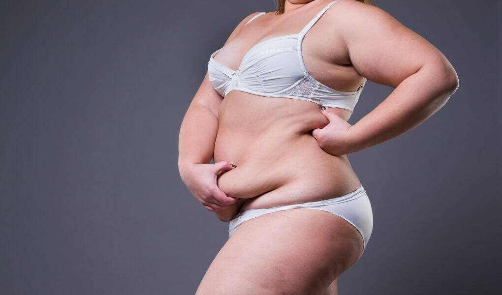 Lipedema antes y despues