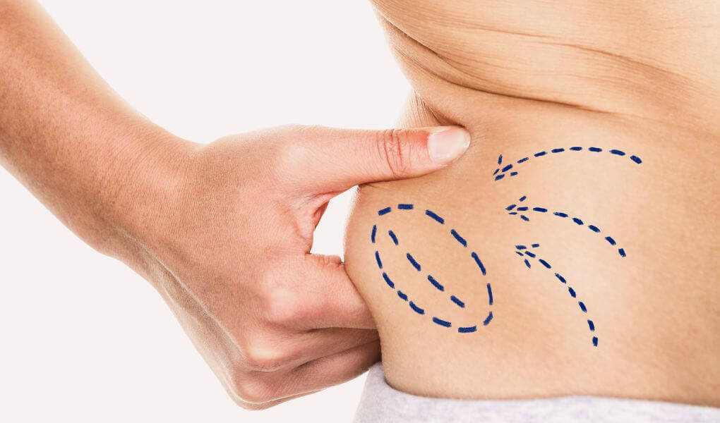 Diferencia entre Liposucción y Lipoescultura