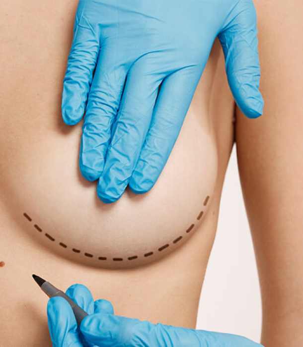 Mamoplastia: Operación de aumento de pecho