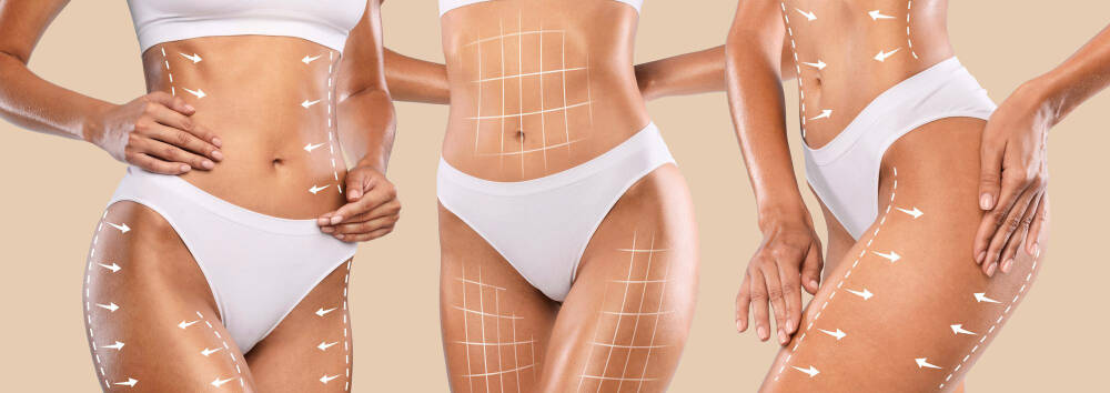 LIPOSUCCIÓN EN SEVILLA LIPOSUCCIÓN EN SEVILLA